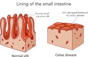 coeliac